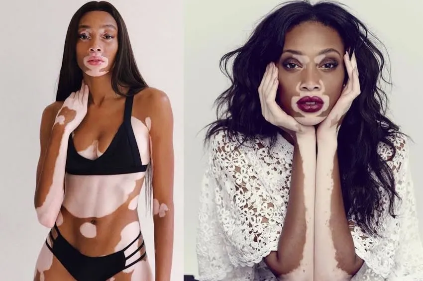 Winnie Harlow: Vitiligo ile Güzellik Standartlarını Yeniden Tanımlayan Bir Model